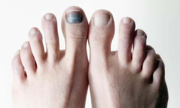 Почему ногти на ногах темнеют и меняют цвет: один из признаков опухоли